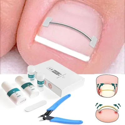 Fils correcteurs pour ongles incarnés