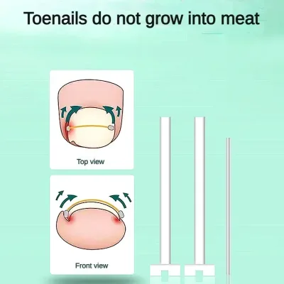 Fils correcteurs pour ongles incarnés, soin des pieds – image 2