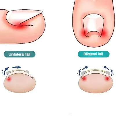 Fils correcteurs pour ongles incarnés, soin des pieds – image 3